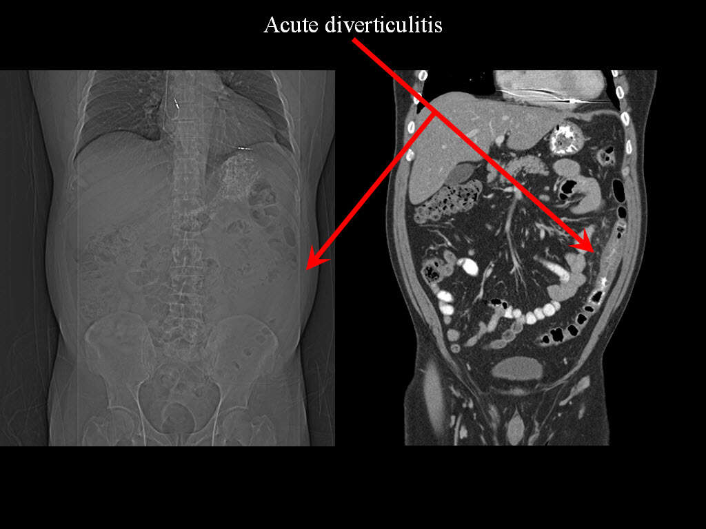 Diverticulitis