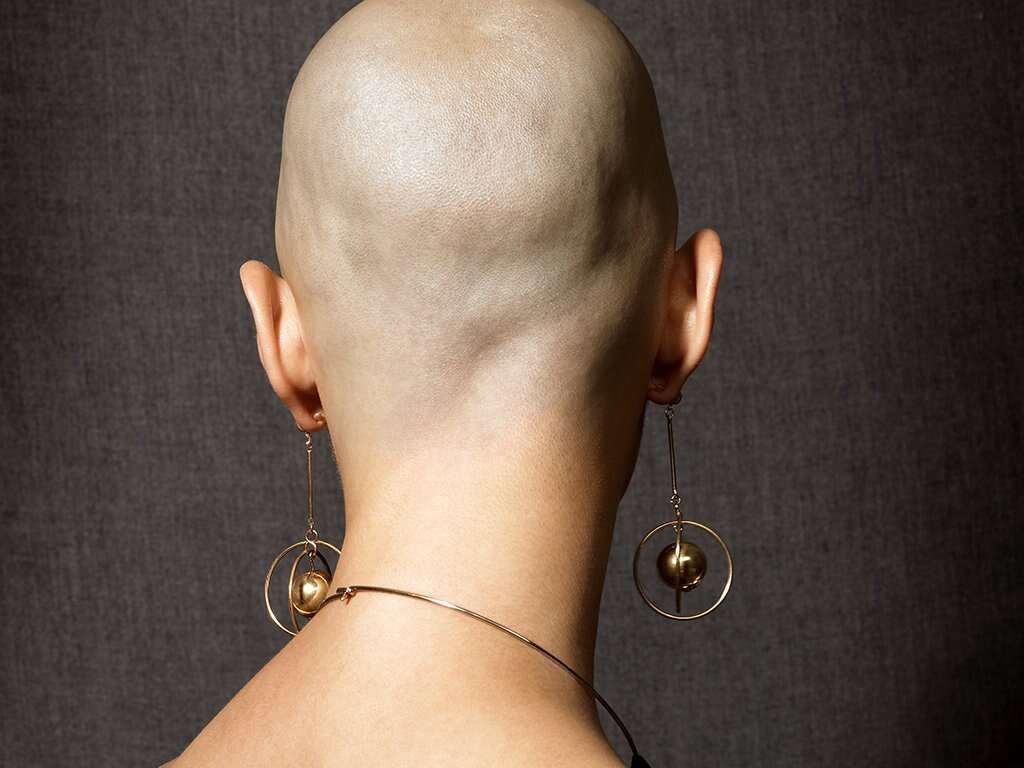 Alopecia