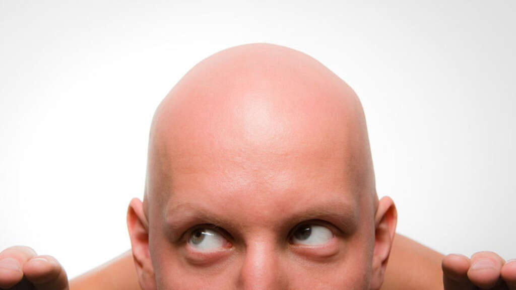 Alopecia