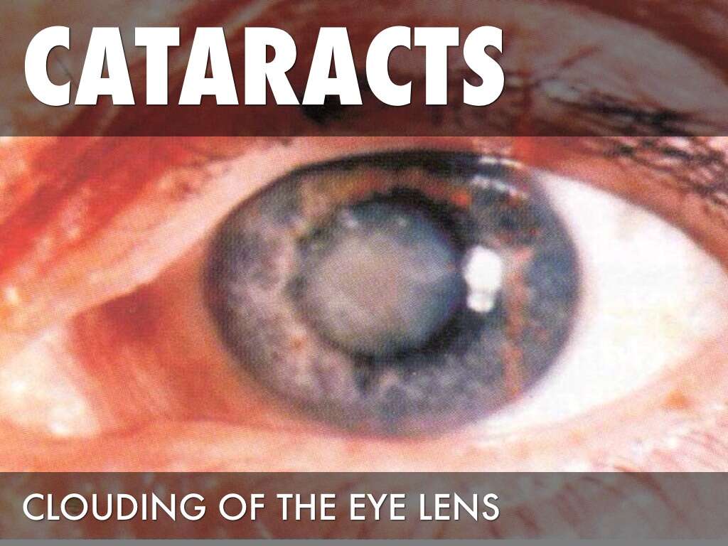 Cataract