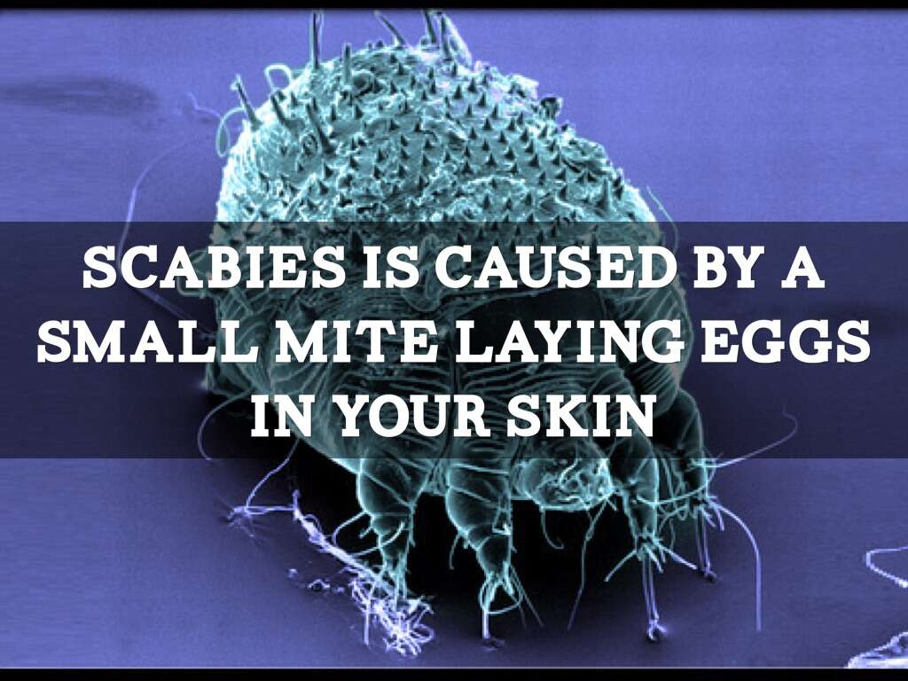 Scabies