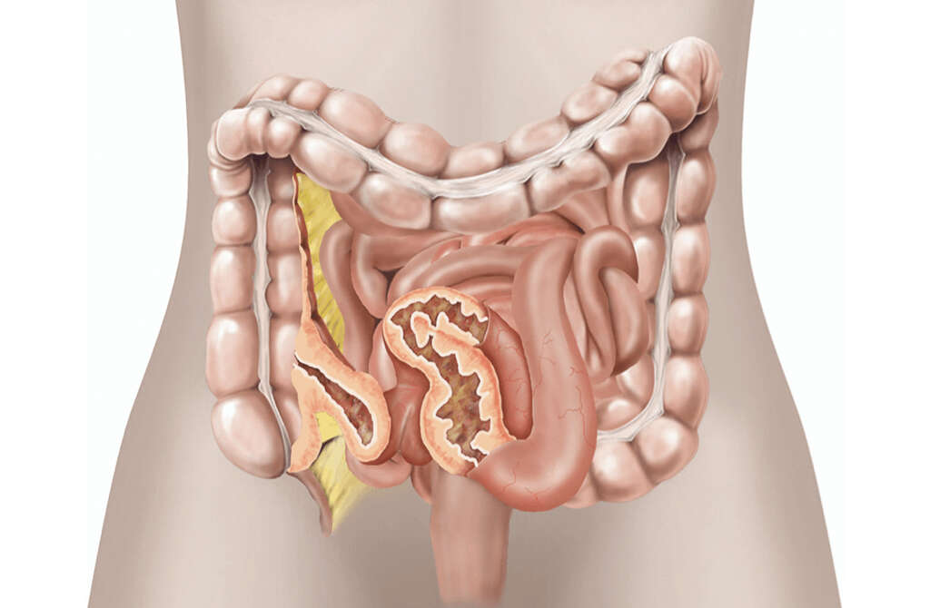 Gastrointestinal Disease