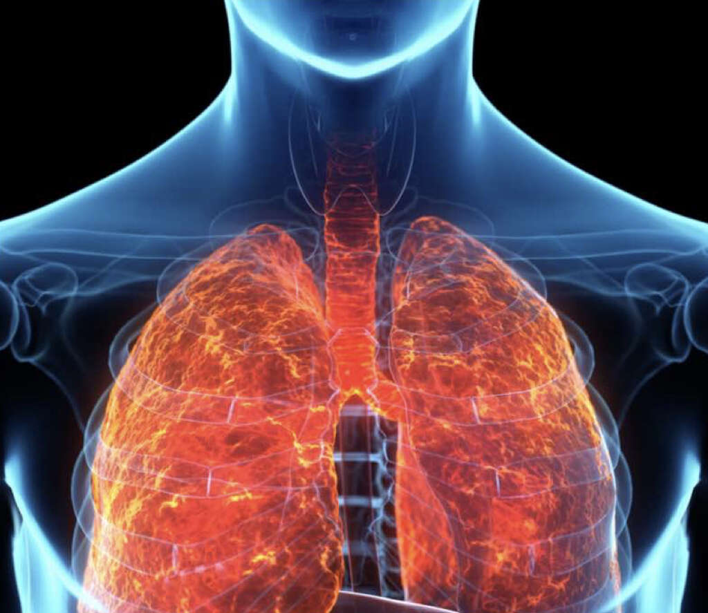 Acute Respiratory Failure