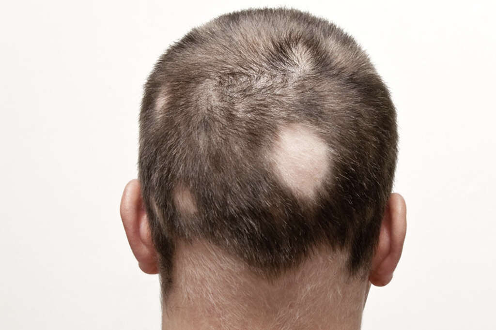 Alopecia Areata