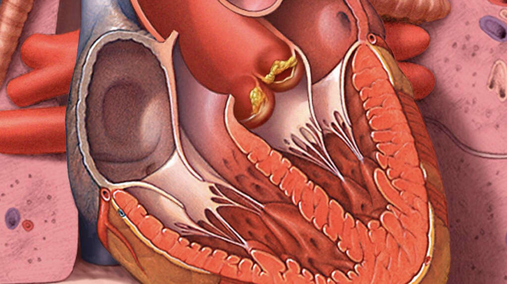 Bartonella