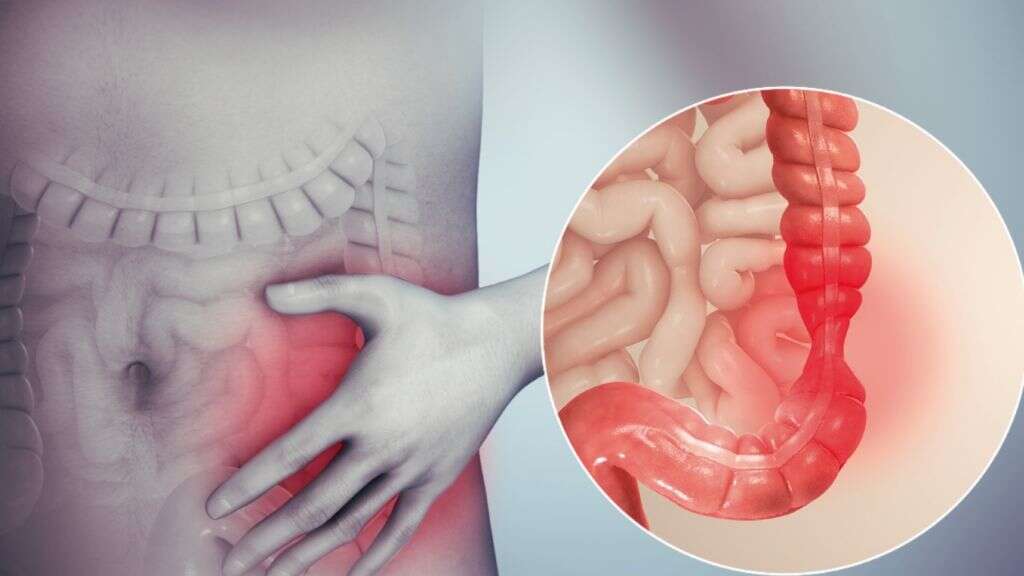 Diverticulosis