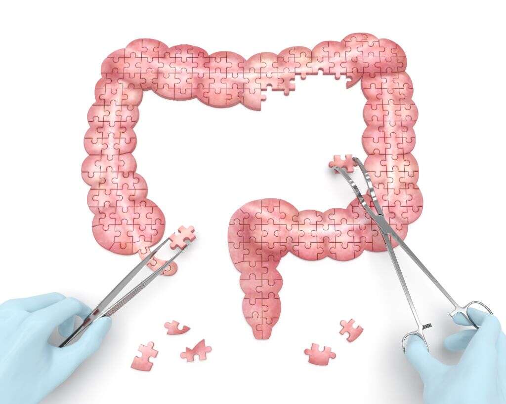 Diverticulosis