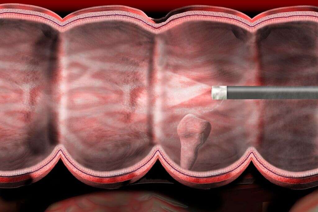 Diverticulosis