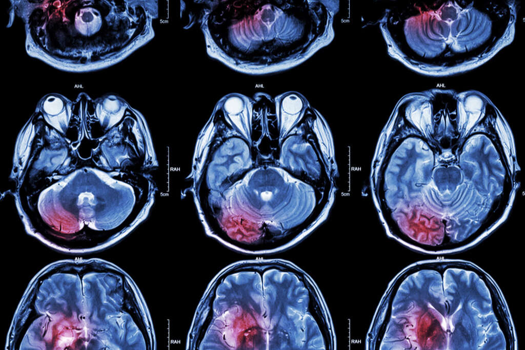 Embolic Stroke