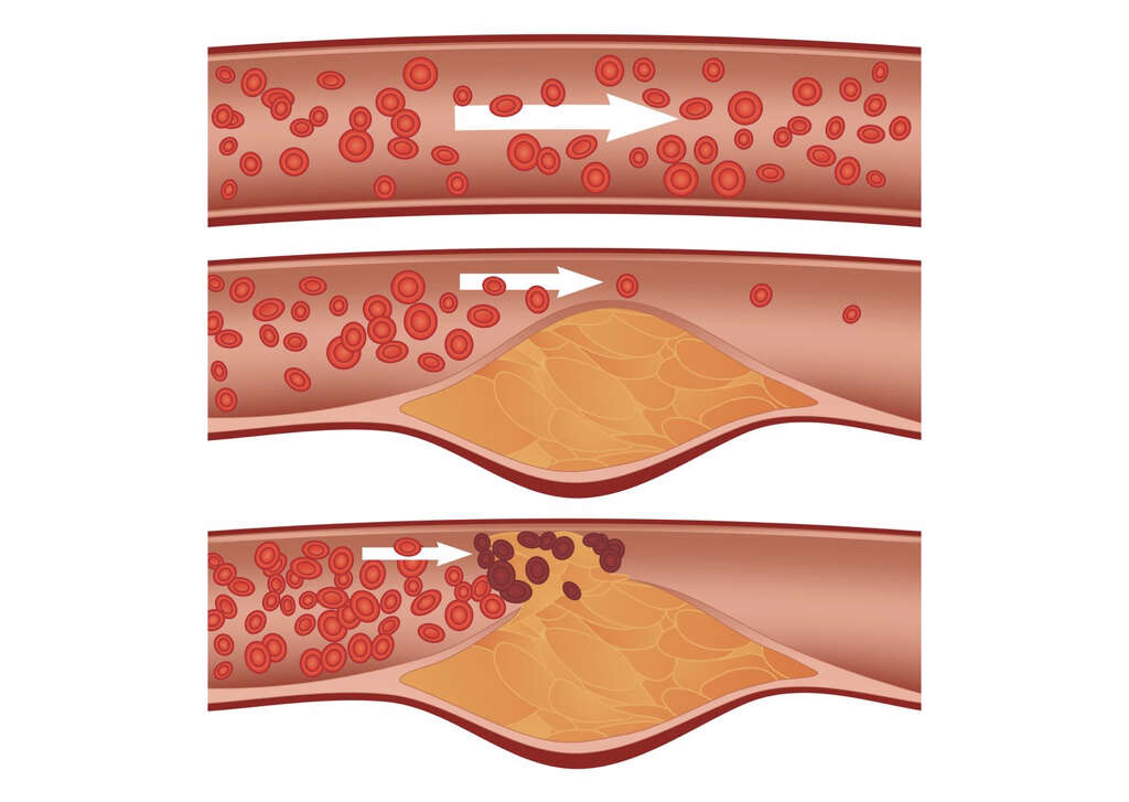 HDL Cholesterol