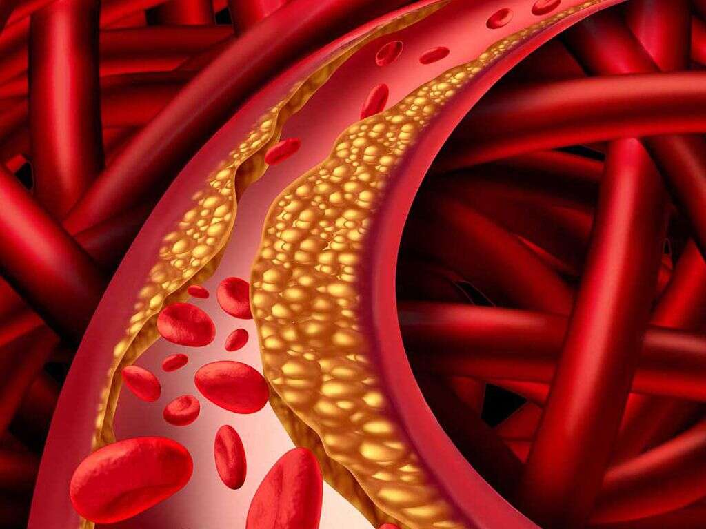 Hypercholesterolemia