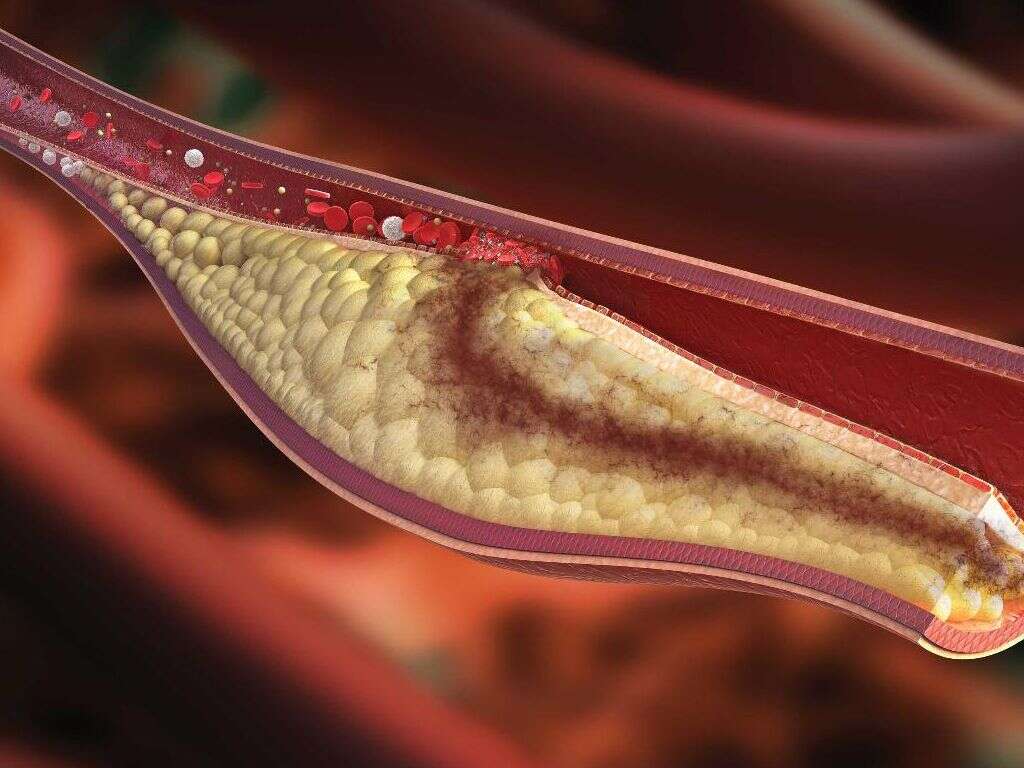 Hyperlipidemia