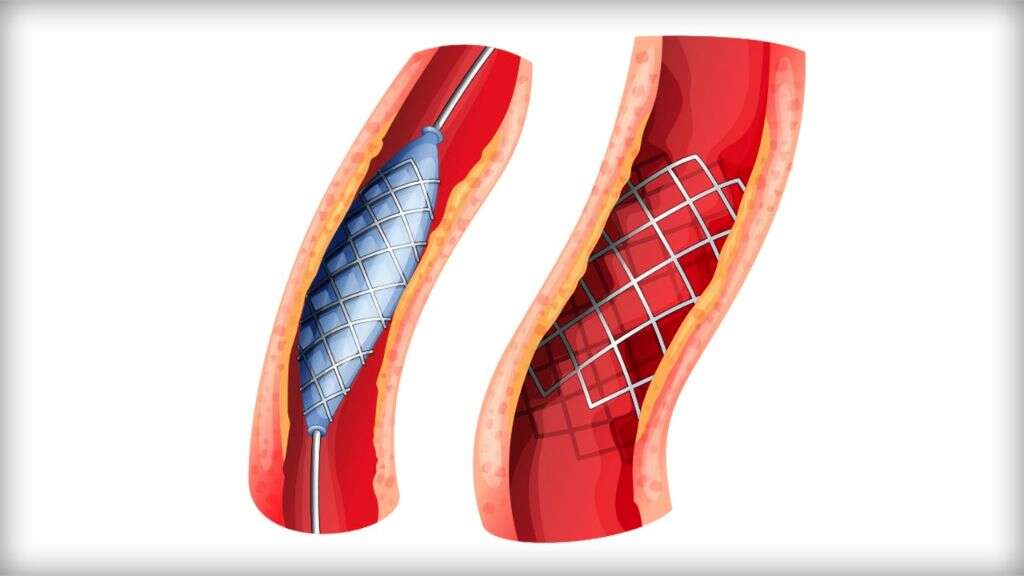 May Thurner Syndrome