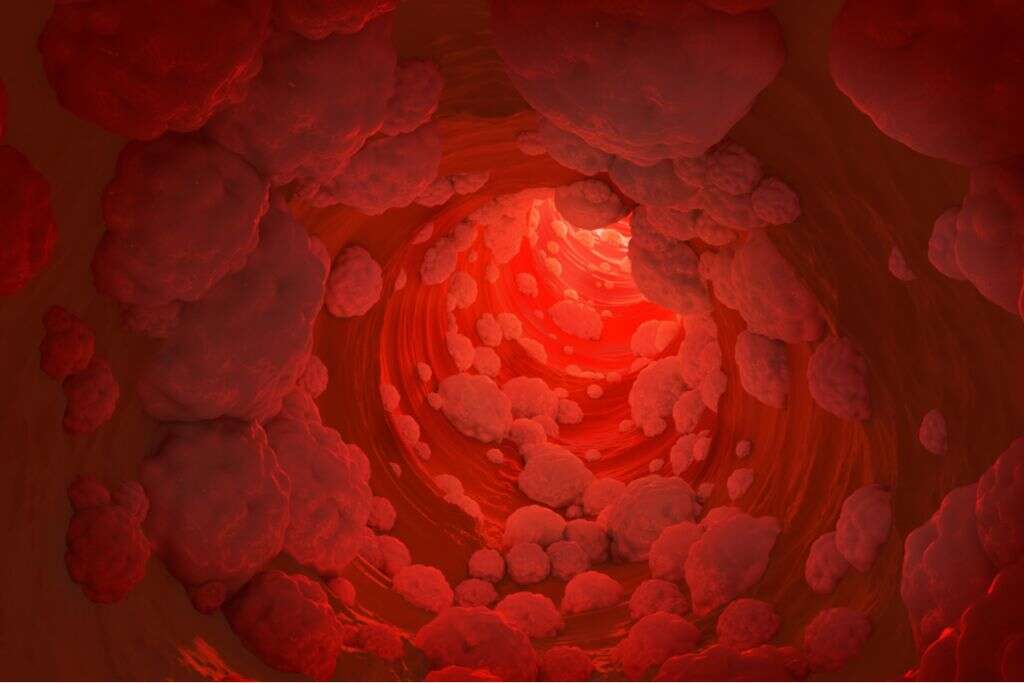 Mixed Hyperlipidemia