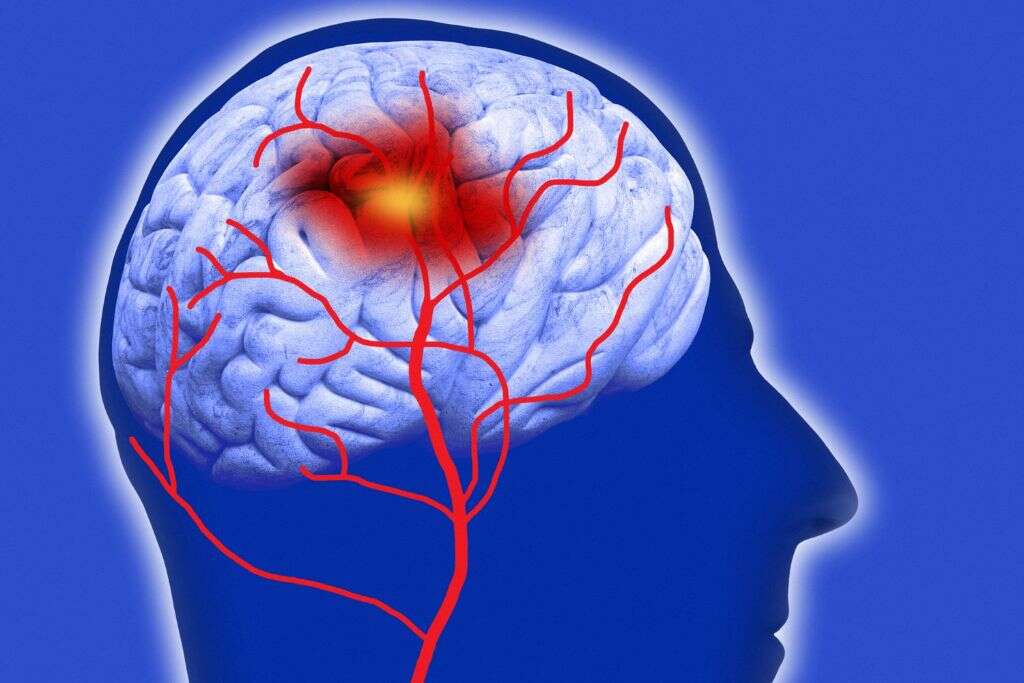 Mixed Hyperlipidemia