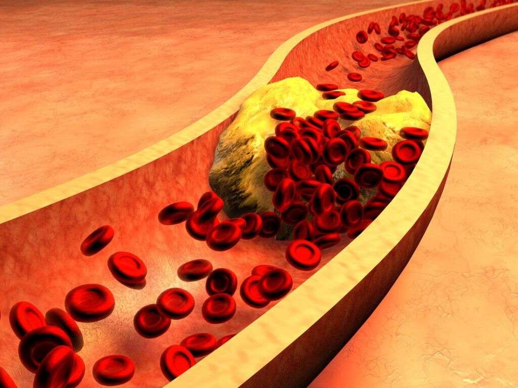 Oxidized Cholesterol