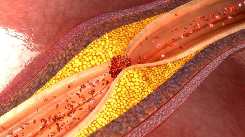 Oxidized Cholesterol