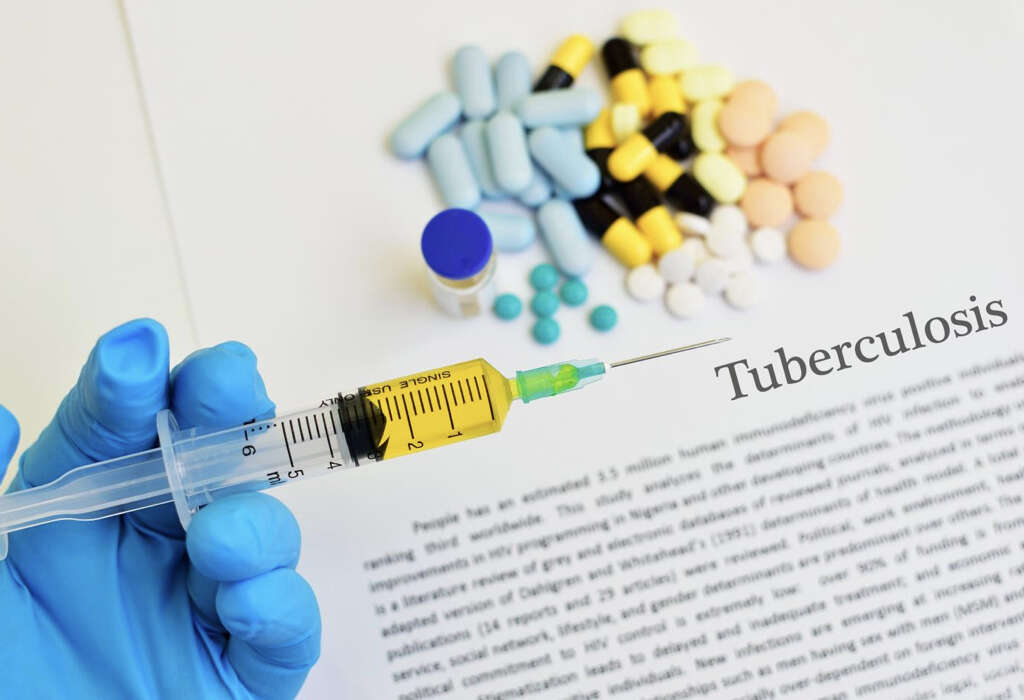 Pulmonary Tuberculosis