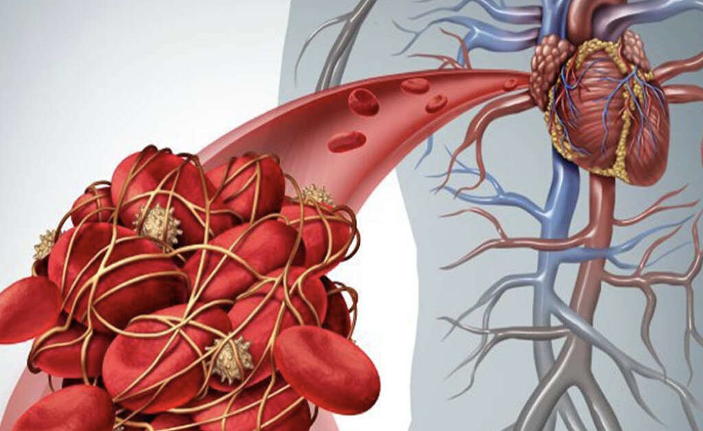 Thrombosis