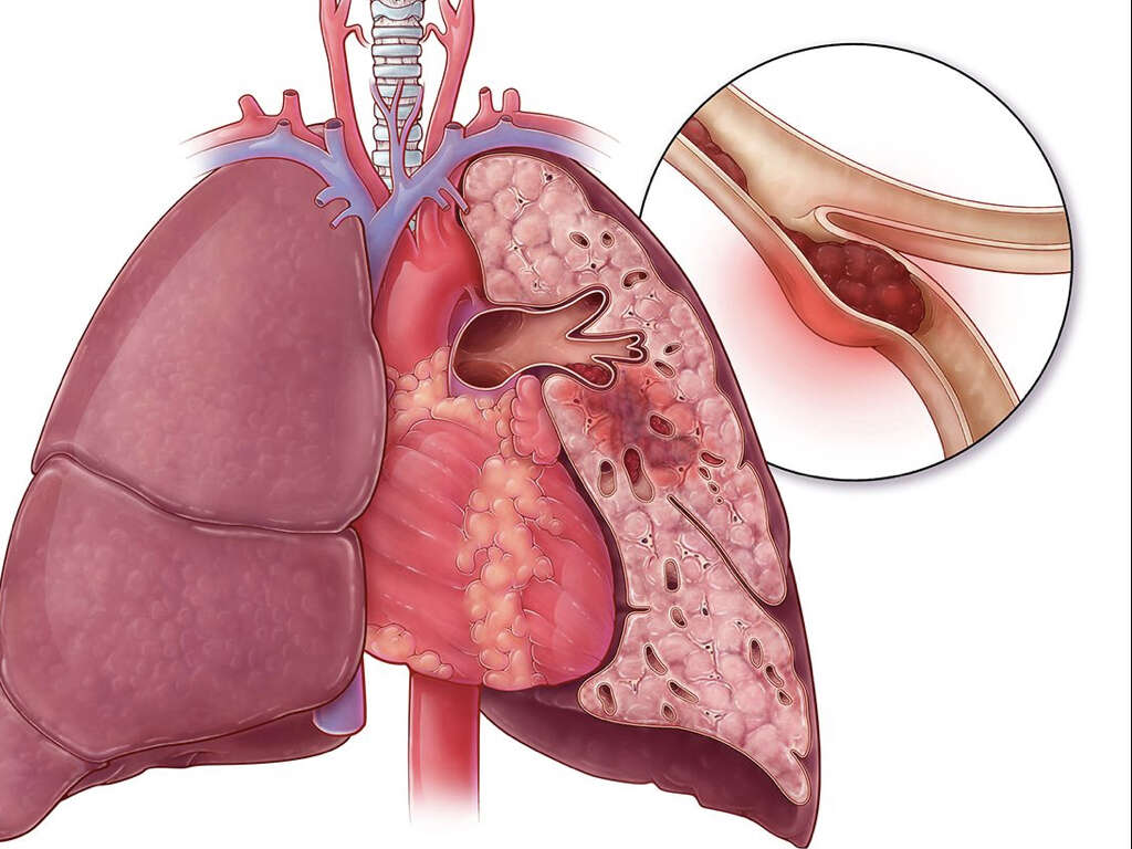 Thrombosis